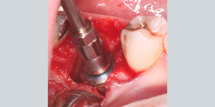 Tooth #30 is extracted and immediately replaced with a Hahn Tapered Implant. thumbnail image