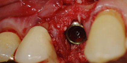 After extracting tooth #5, a Hahn Tapered Implant is immediately placed and a provisional crown delivered, leading to an esthetic, predictable final restoration. thumbnail image