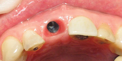 A central incisor is extracted and immediately replaced with a Hahn Tapered Implant and provisional crown, facilitating an esthetic final outcome. thumbnail image