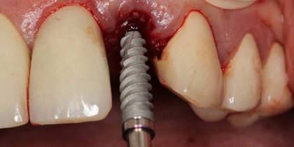 A Hahn Tapered Implant is immediately placed into an extraction socket to replace a grossly decayed tooth #10, establishing the stability needed for provisionalization and a predictable final restoration. thumbnail image