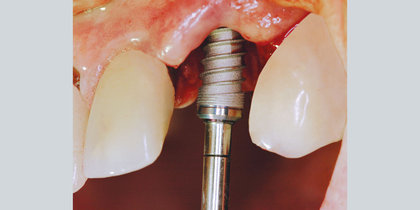 A large periapical defect necessitates precise angulation of a Hahn Tapered Implant in the extraction site prior to temporization, establishing a stable foundation for the eventual restoration. thumbnail image