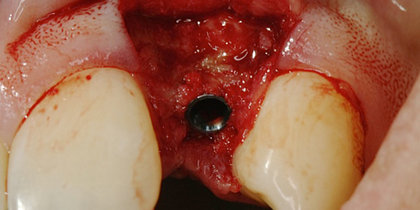 A 3.0-mm-diameter Hahn Tapered Implant is used to restore the edentulous space resulting from a congenitally missing lateral maxillary incisor. thumbnail image