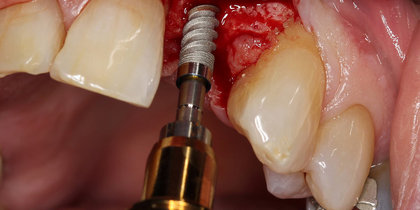 Tooth #10 is restored using a narrow-diameter Hahn Tapered Implant. thumbnail image