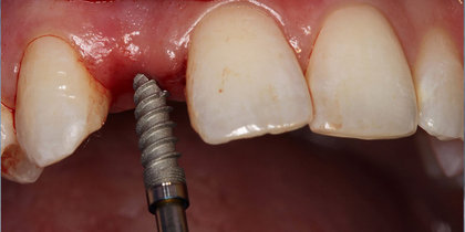 Tooth #7 is restored using a narrow-diameter Hahn Tapered Implant. thumbnail image