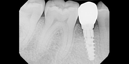 A narrow edentulous space in the area of tooth #29 is restored using a 3.5-mm-diameter Hahn Tapered Implant. thumbnail image