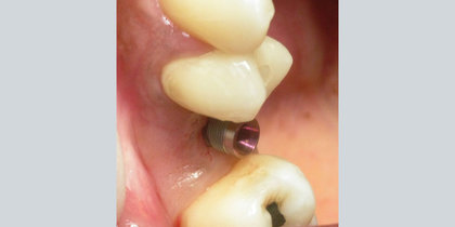 An edentulous space in the area of tooth #4 is restored with a Hahn Tapered Implant. thumbnail image