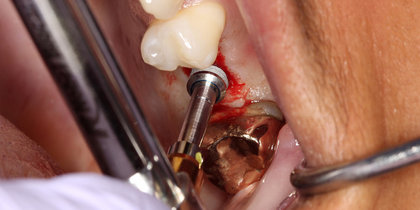 Tooth #14 is replaced using a Hahn Tapered Implant. thumbnail image
