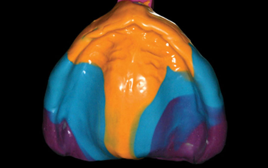 Building the Edentulous Impression - A Layering Technique Using 