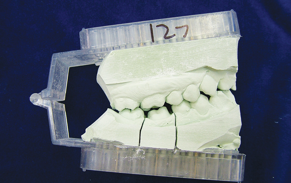 Optimizing Occlusal Results for Crown & Bridge Prostheses