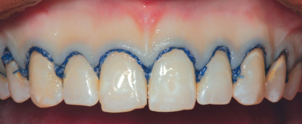 thumbnail image 2 of 2 Packs Aesthetic Composite Lingual Buttons – Orthodontic Dental Bondable 2 of 2