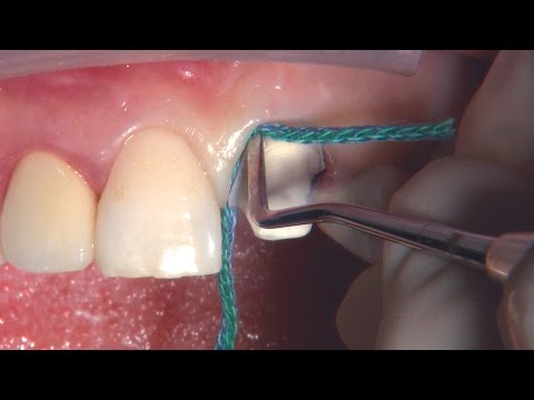 Dr. DiTolla's Clinical Tips – Intraoral Repair Kit