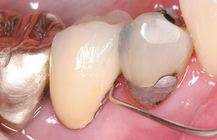Simplifying Accurate Evaluation: Adjustment of Proximal Contacts