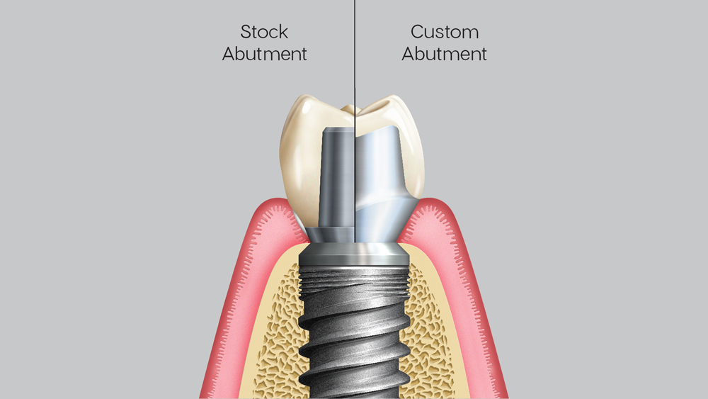 Clinical Consideration: An Alternative Technique to Eliminate Retained  Cement Around Implant Restorations