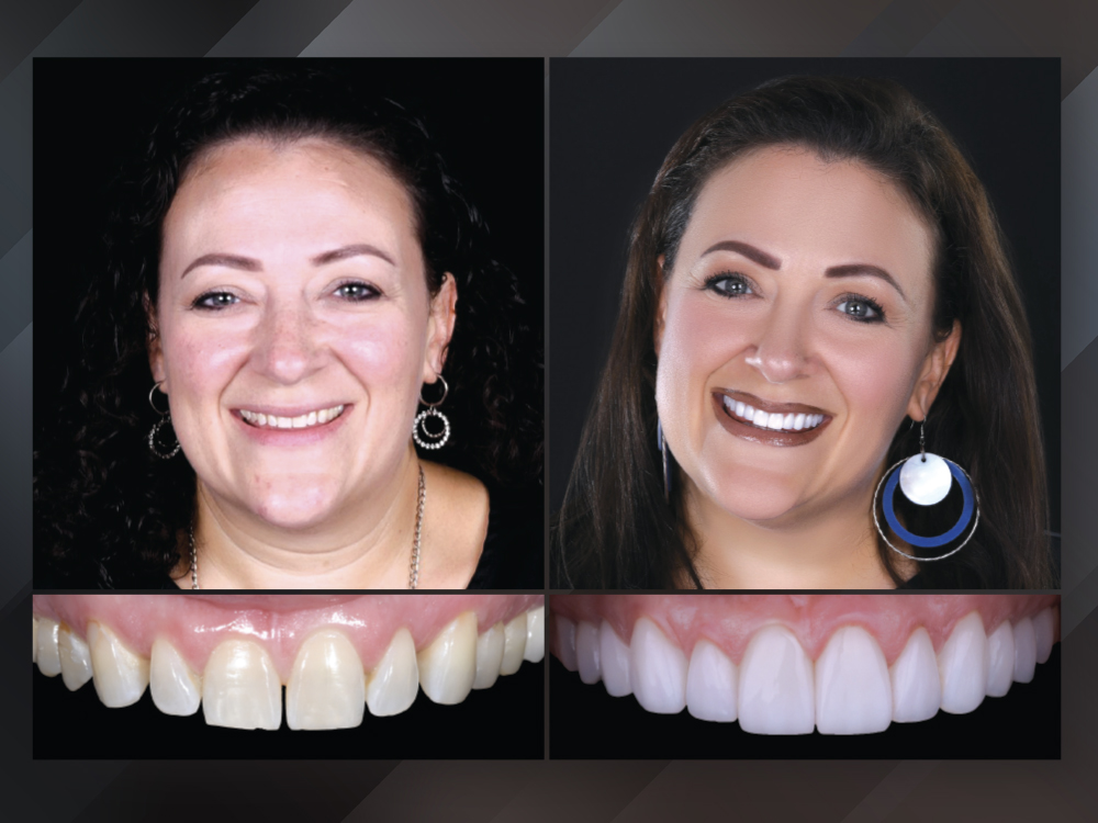 Ceramic Dental Veneers - Anterior Teeth Veneers For Whitening & Restoration (LMS)
