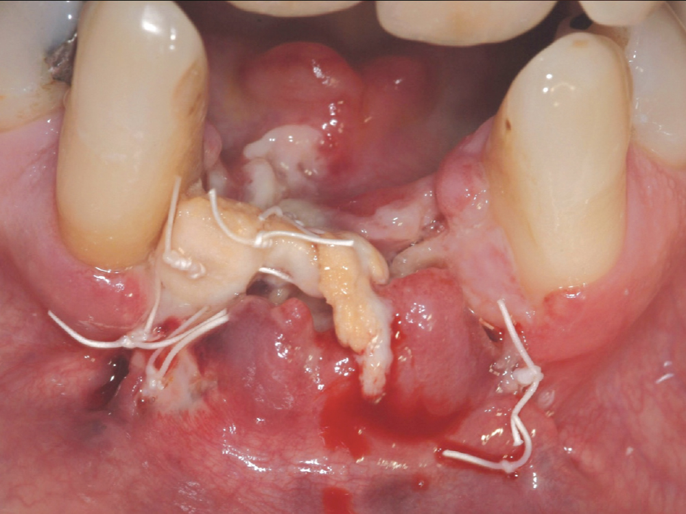 Implant Complications Linked to Tobacco and Cannabis