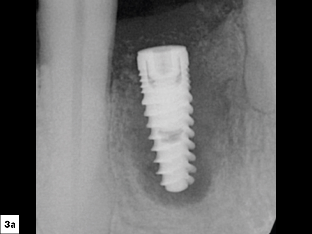 Implant Complications Linked to Tobacco and Cannabis