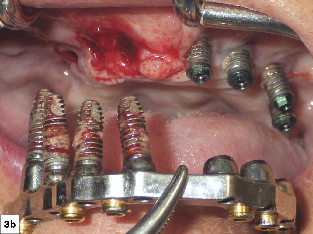 chewing tobacco and dental implants Implant Complications Linked to Tobacco and Cannabis