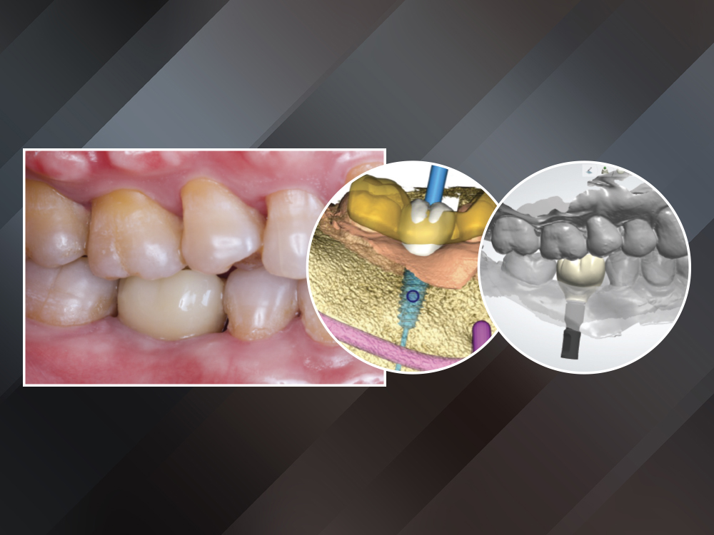※訳 TECHNO MEDICAL DENTAL キット Digital Implant Workflow: From Surgical Plan to Final Crown