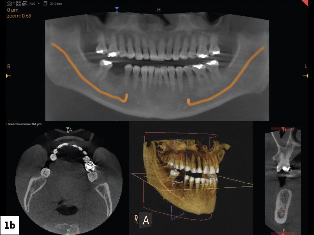 Digital Implant Workflow: From Surgical Plan to Final Crown
