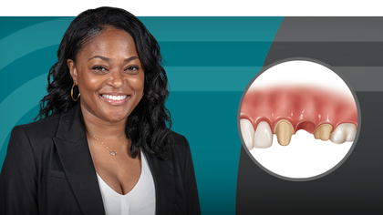 Crown & Bridge Essentials: From Preparation to Final Delivery image