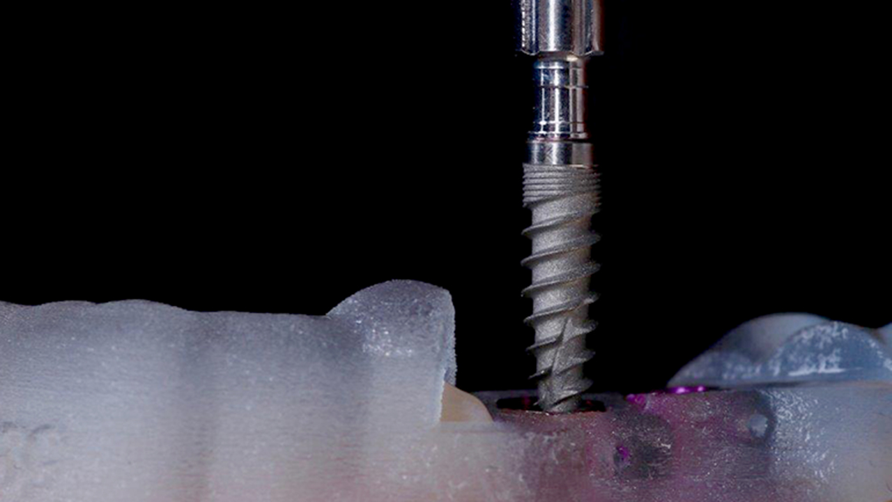 Making Implants a Profitable Part of Your Practice Simplified