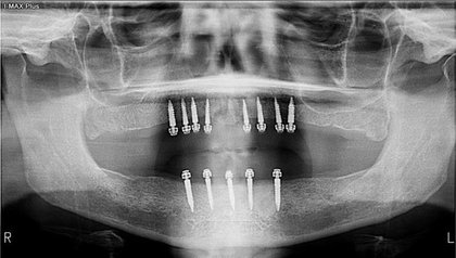 Mini Implants for General Dentists image
