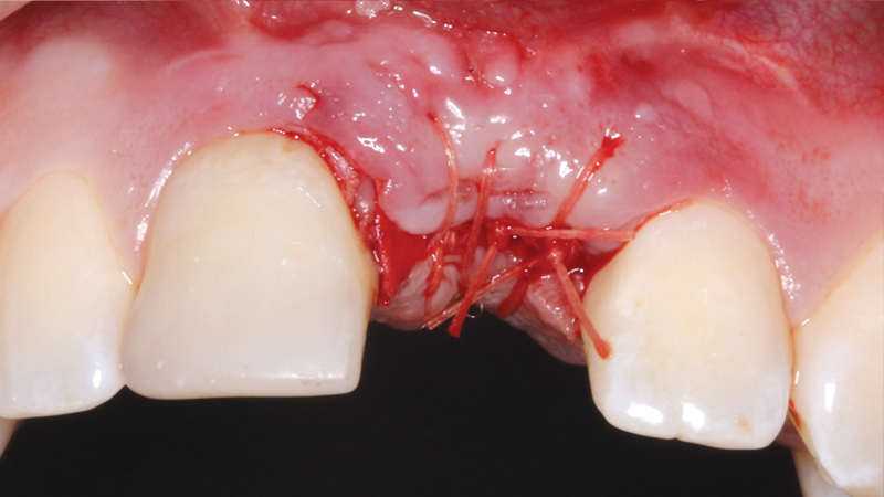 Implanty Dental Synthetic Bone Graft Cubes – β-TCP, Sterile Resorbable, 0.5cc, 4 Cubes Or 2 Cubes