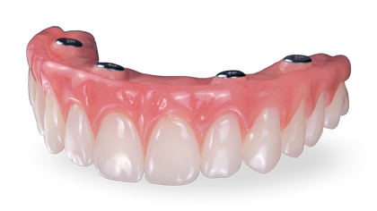Screw-Retained Hybrid Denture Image image