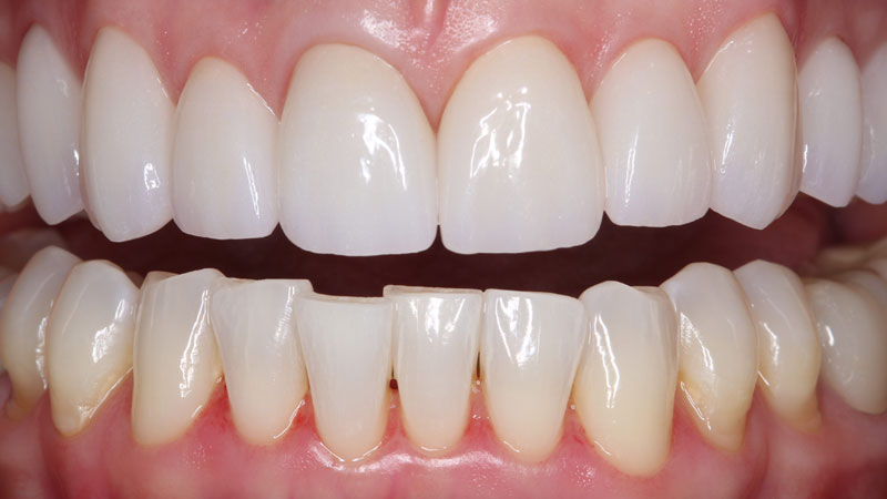 AcrylX Xthetic Temp Tooth Shade Acrylic (Crown and Bridge High