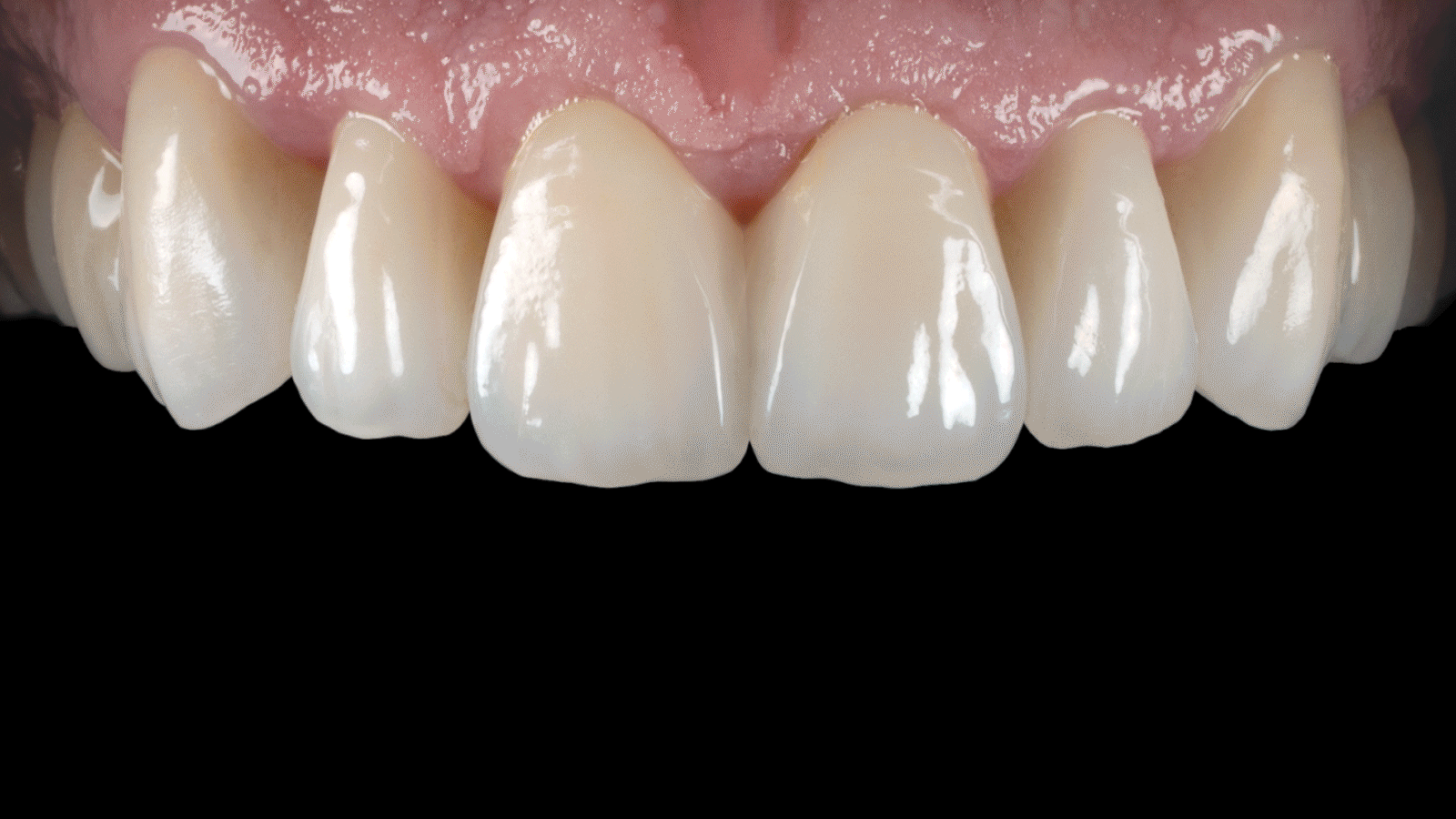 BruxZir Glass - Product Image image