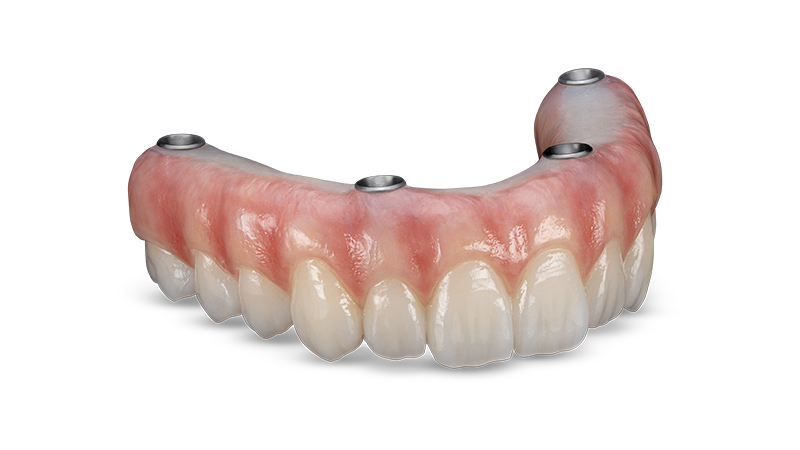 BruxZir® Implant Prosthesis image