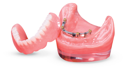 Locator CAD/CAM-Milled Bar Overdenture Signature Image image