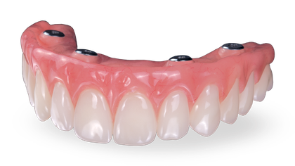 Screw-Retained Hybrid Denture Image image