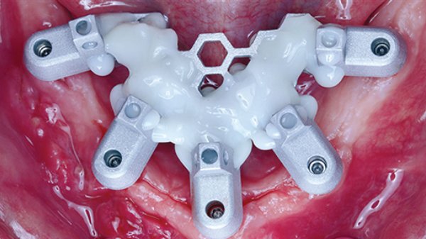 Enhance Digital Workflows with Precision Scan Bodies