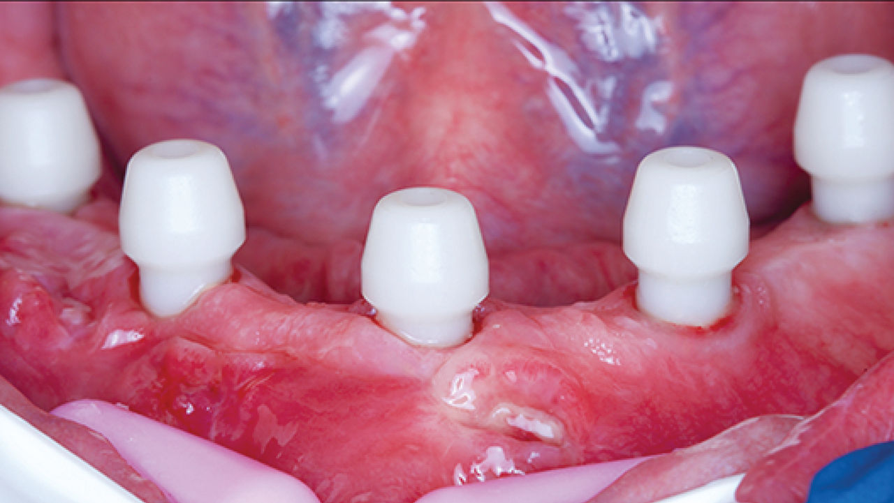 OPTISPLINT Image 2