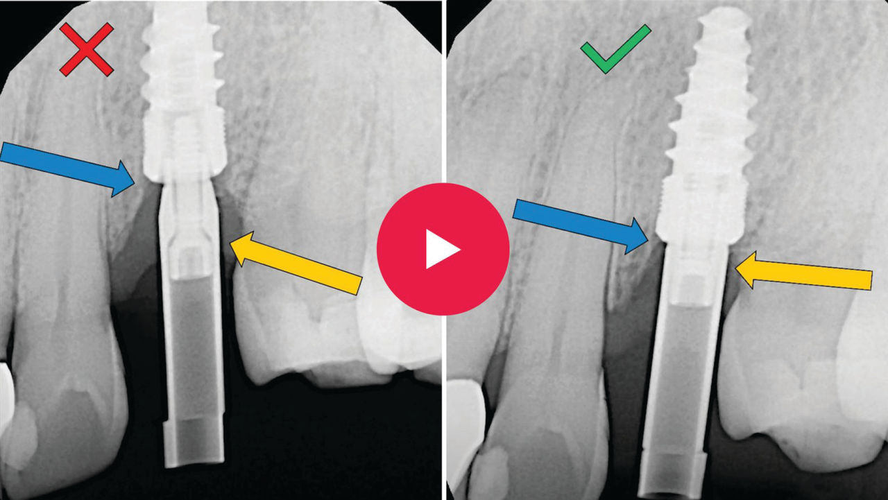 •	Evaluate the teeth adjacent to the implant site and make any necessary modifications to contact areas. Broad, parallel contacts are necessary for a clear path of insertion. They also should be smooth and free of data scatter.