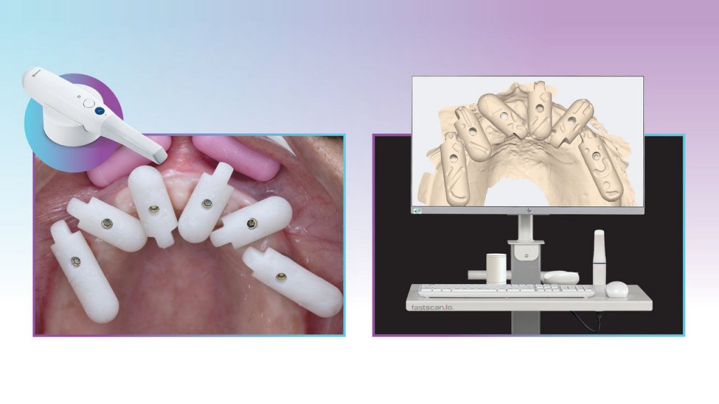Enhance Digital Workflows with Precision Scan Bodies