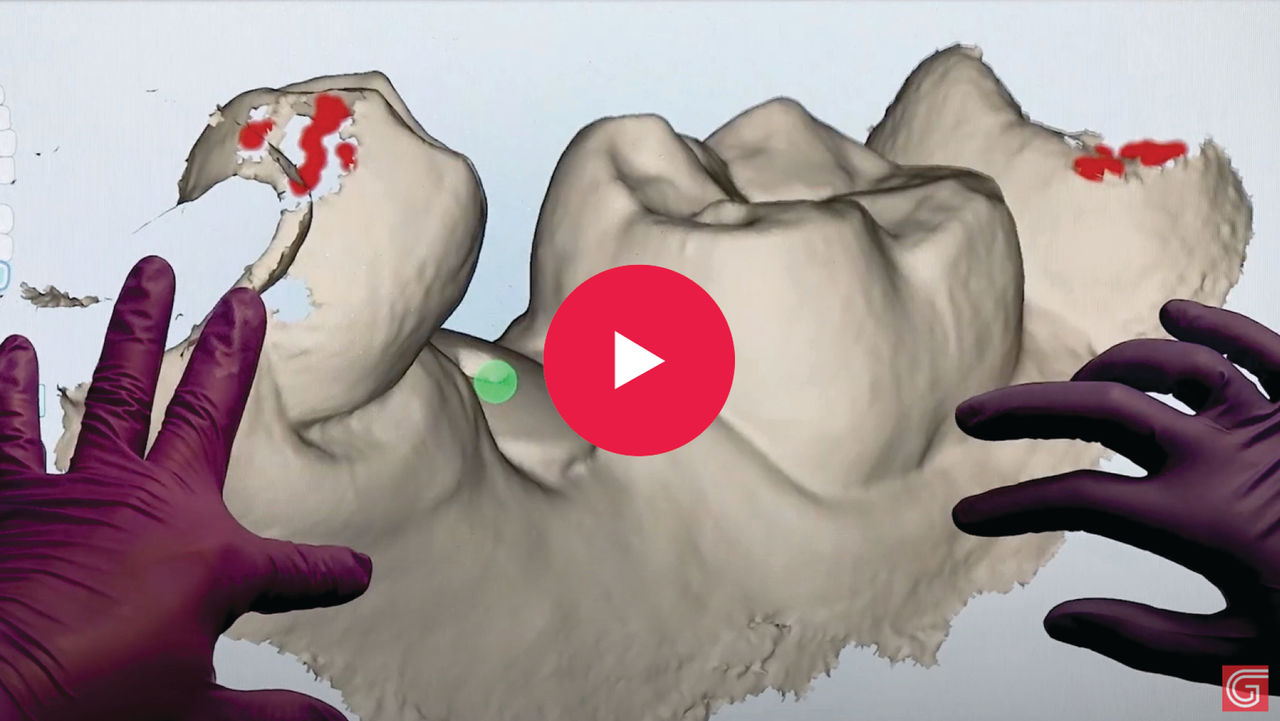 •	Obtain an accurate digital bite registration to ensure the implant has accurate occlusion, reducing the likelihood you’ll need to make adjustments during delivery. Taking the bite with the provisional or healing abutment in place will ensure the scan body does not interfere with or alter the bite.