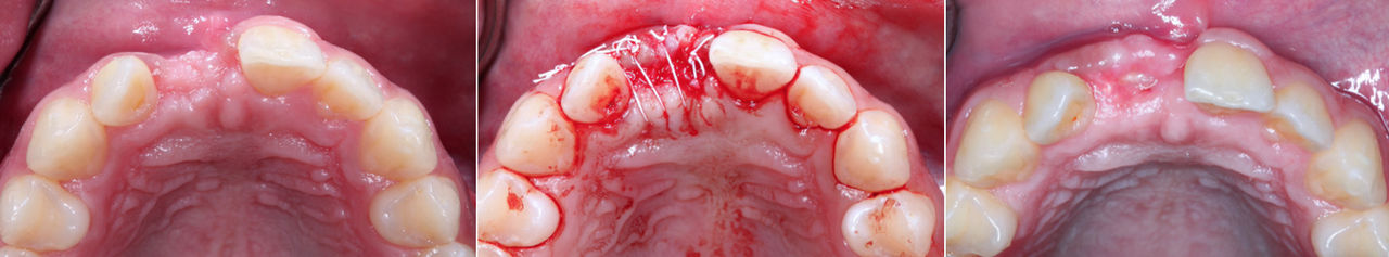 Ridge augmentation site pretreatment, post-surgery and post-healing. Note the improved horizontal width after the ridge has healed.