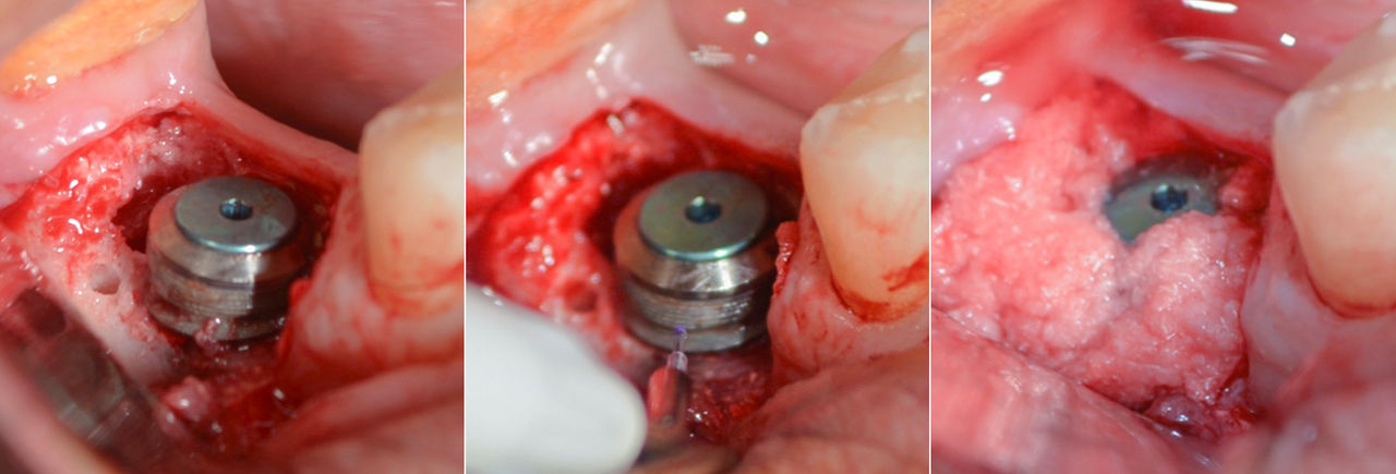 At this site where a large buccal peri-implant defect was present (left), the implant surface was thoroughly cleaned and debrided (center). Then, OsteoGen Plug material was used to graft the defects (right)