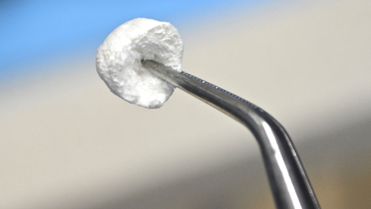 The tip of an OsteoGen Plug is a great choice for grafting a vertical-approach sinus lift.