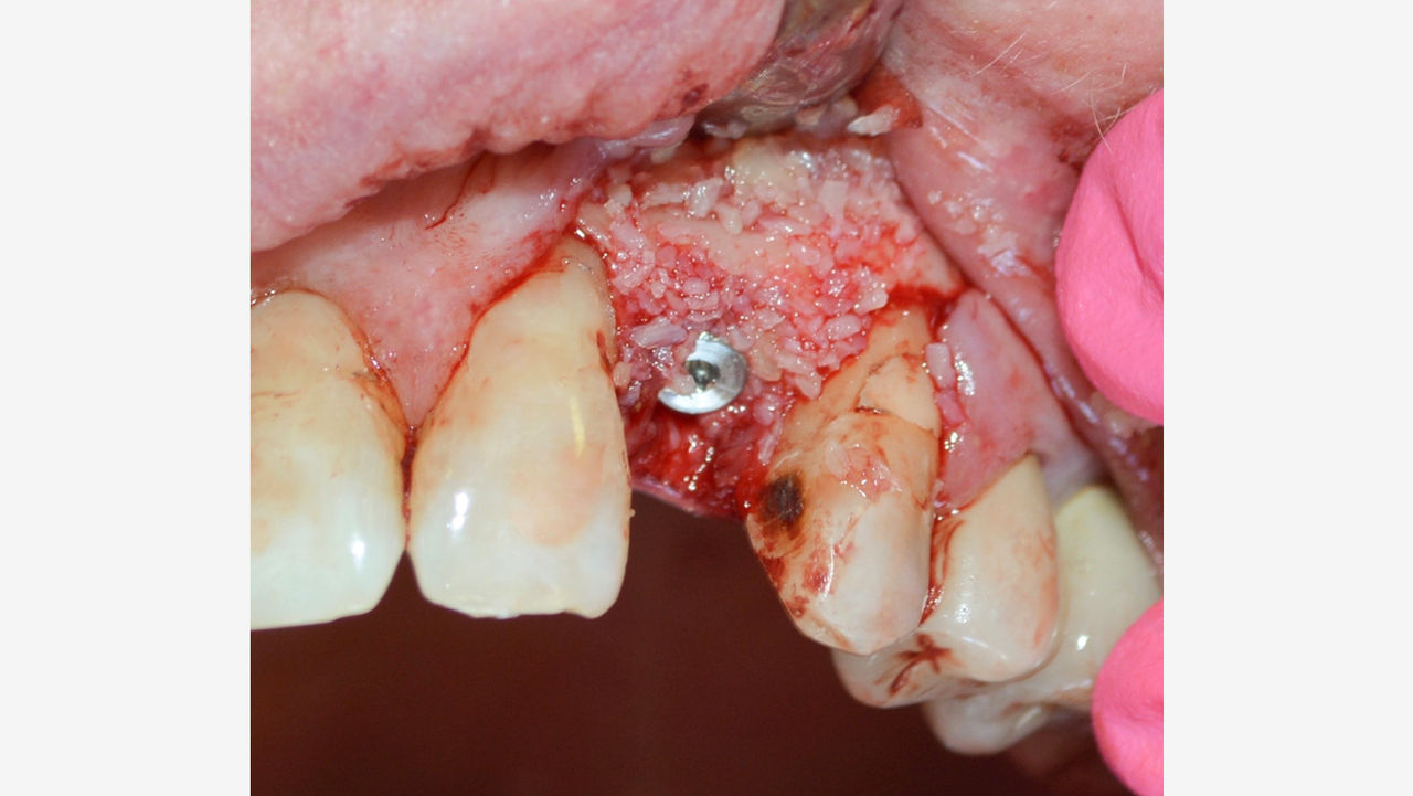 Here, Newport Biologics Mineralized Cortico/Cancellous Allograft Blend is used to fill the gaps between an immediately placed implant and the walls of the extraction socket.