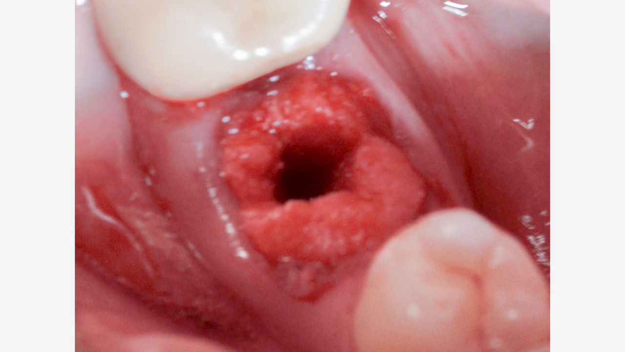 An OsteoGen Plug can be placed in an extraction socket to fill the gap prior to implant placement.