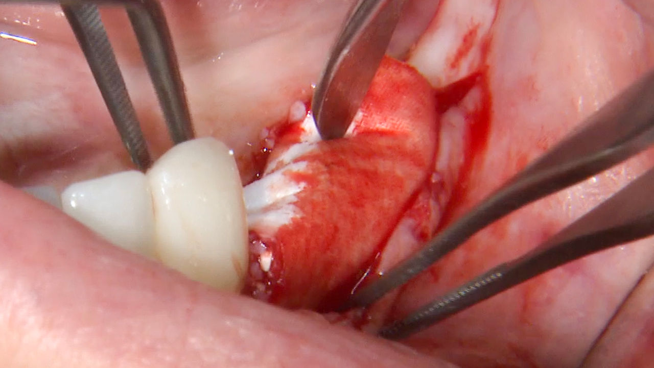 Placement of Newport Biologics Resorbable Collagen Membrane 4-6 at a site where a ridge augmentation procedure has been performed.