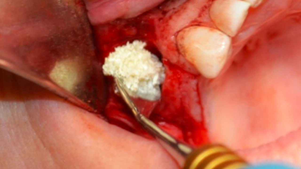 Here, Newport Biologics Mineralized Cortico/Cancellous Allograft Blend is used to graft the site of a lateral-approach sinus lift.
