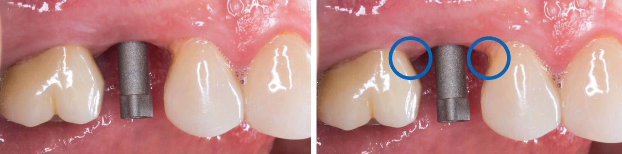 Intraoral Scanning: Natural Teeth vs. Implants