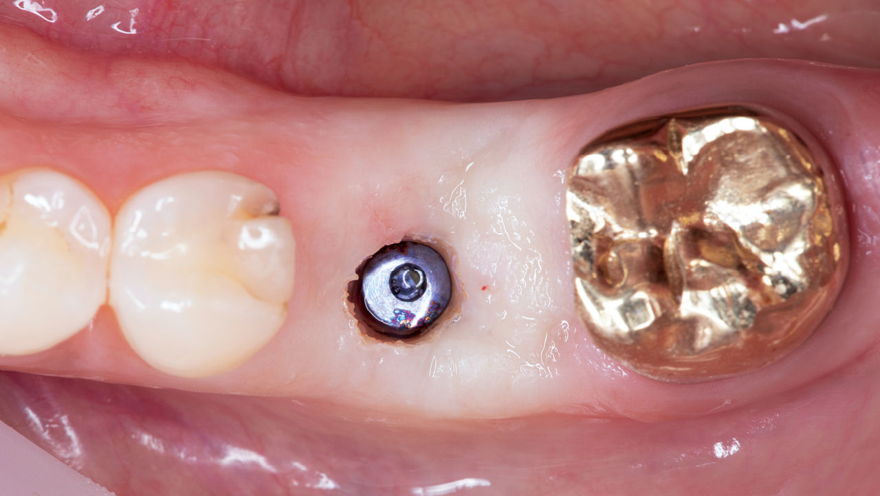 Mistake #4: Soft Tissue Interference