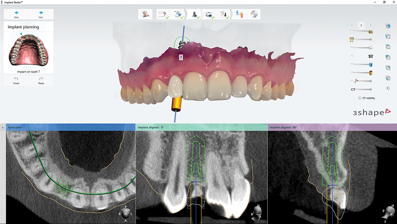 CBCT scan and digitized impression