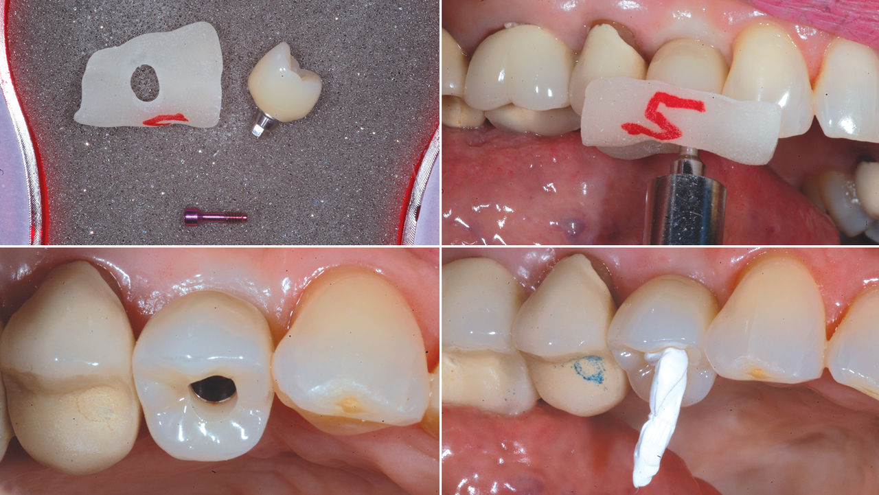 Screw-Retained Crowns