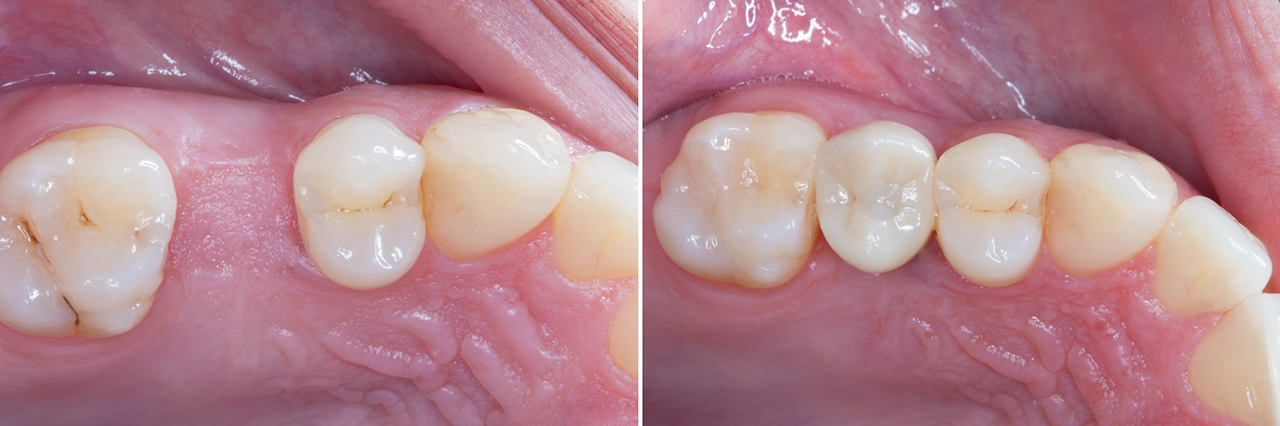 Favorable positioning for screw-retained crown